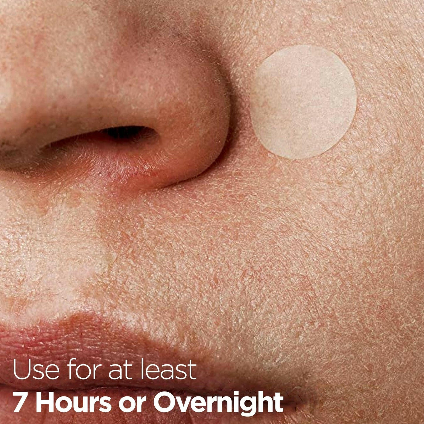 Acne Pimple Healing Hydrocolloid Patch With Salicylic Acid+Tea Tree Oil+Centella Asiatica By Healer Labs London