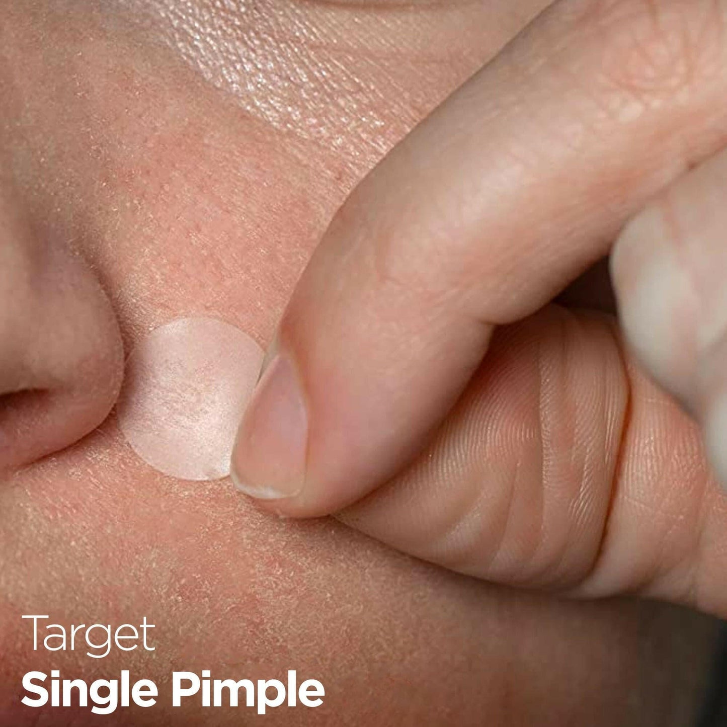 Acne Pimple Healing Hydrocolloid Patch With Salicylic Acid+Tea Tree Oil+Centella Asiatica By Healer Labs London